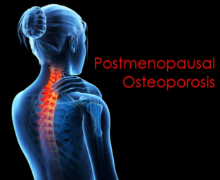 Postmenopausal Osteoporosis - Μετεμμηνοπαυσιακή Oστεοπόρωση